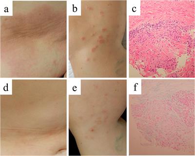 Case report: Generalized granuloma annulare successfully treated with baricitinib in two cases